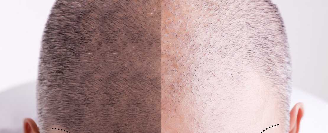 Guide: The Cost of Various Hair Loss Treatments