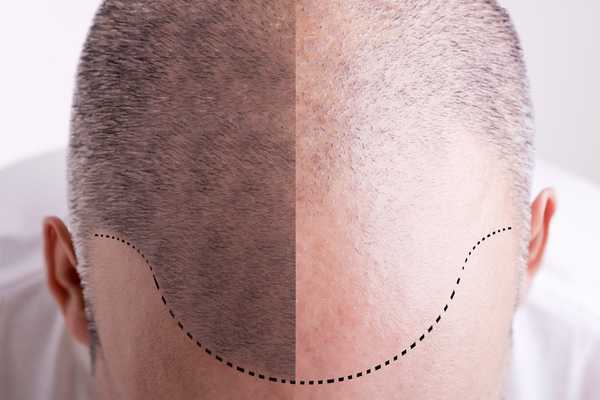 Guide: The Cost of Various Hair Loss Treatments